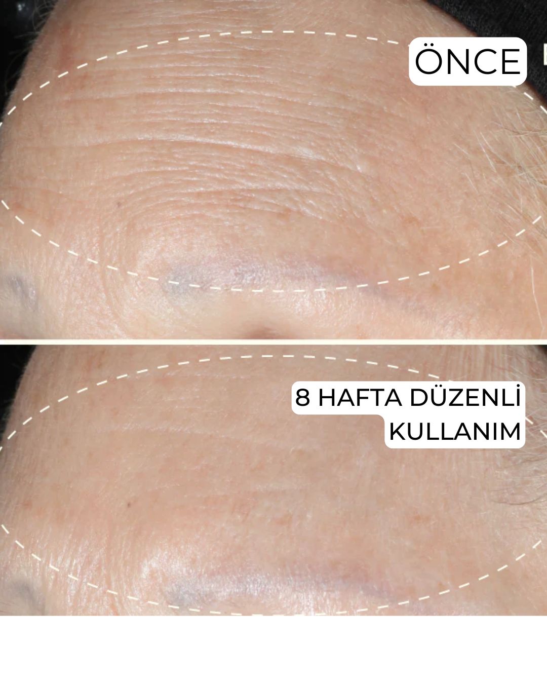 Yaşlanma Karşıtı Botoks Etkili Krem